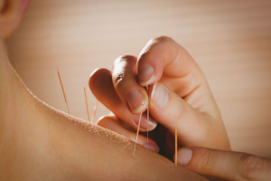 Benefits of Acupuncture Therapy