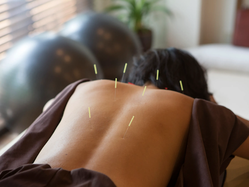 Cho Acupuncture | Exploring Traditional Chinese Medicine: Acupuncture, Cupping, and Gua Sha